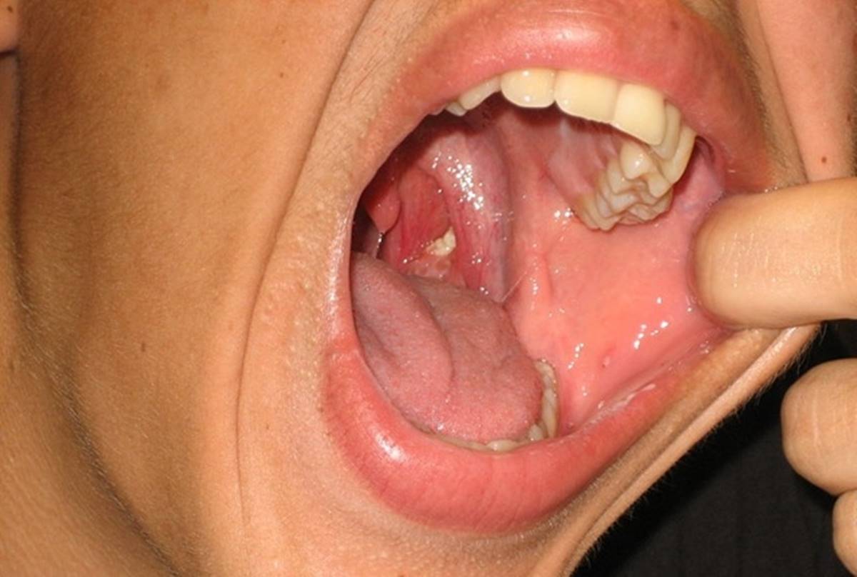 Bolinhas brancas na garganta que causam mau hálito