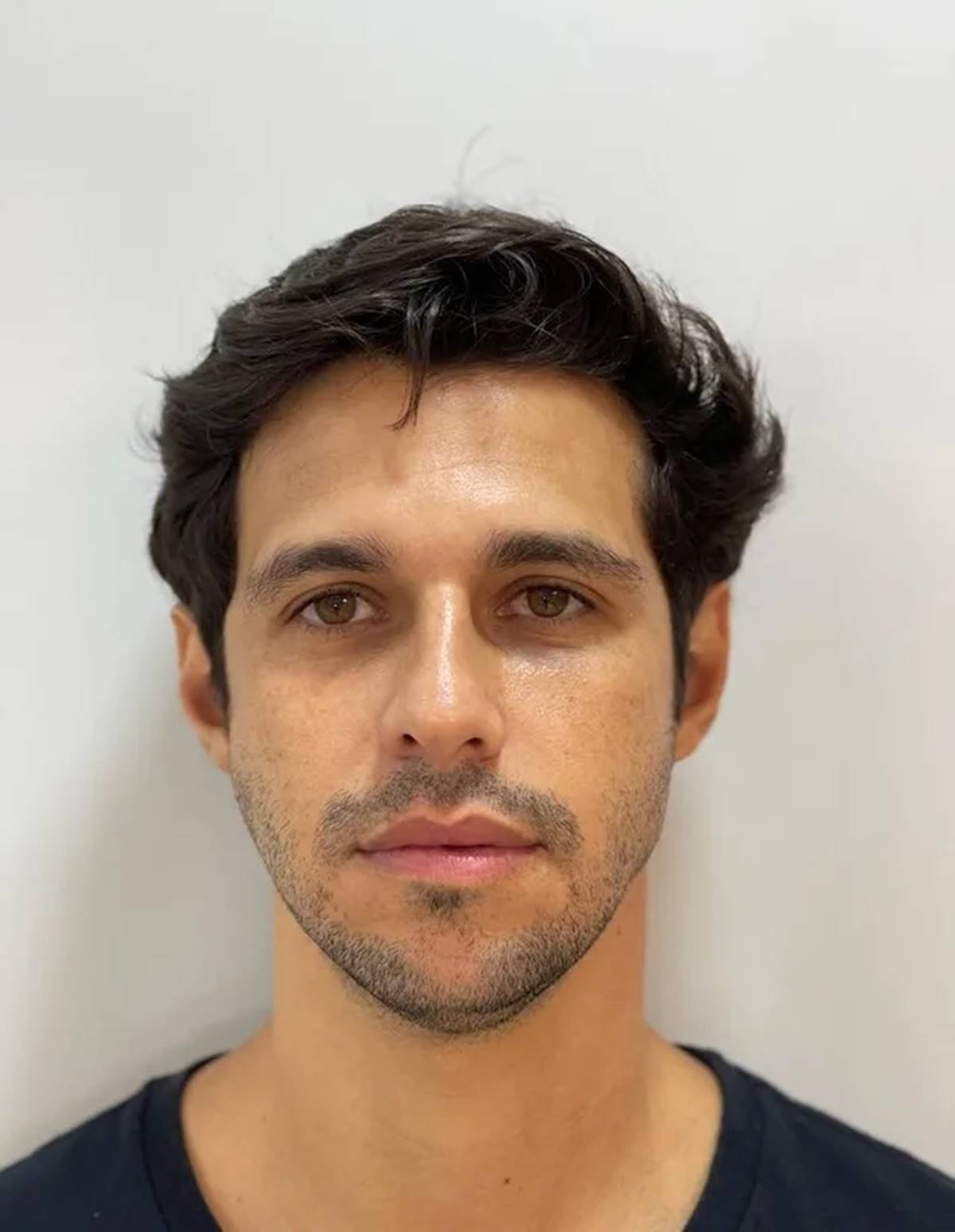 BBB22: Beleza de Rodrigo é resultado de harmonização facial, entenda