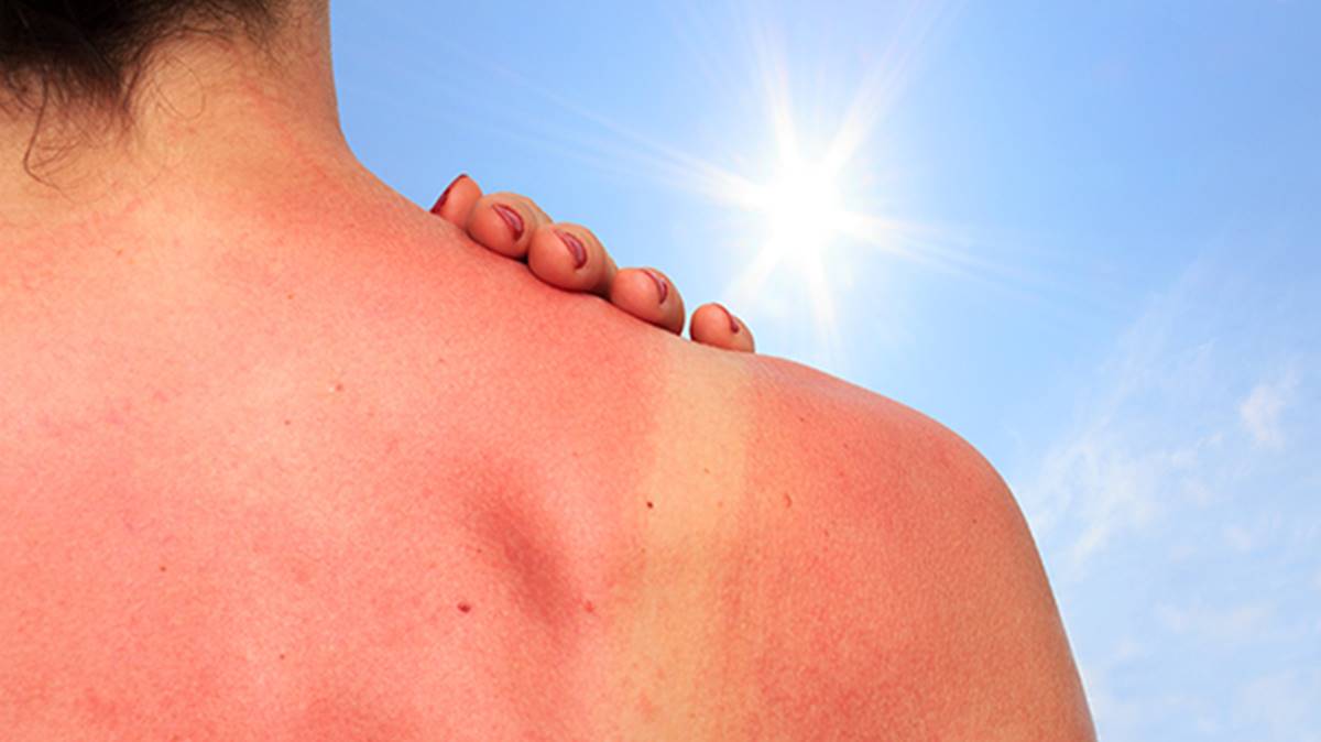 Queimaduras de sol: como se livrar do ardor na pele