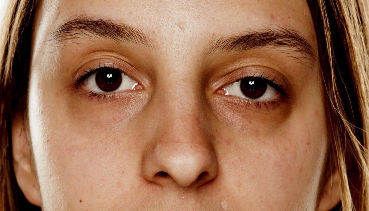 O que causa olheiras escuras? Confira causas e principais tratamentos disponíveis